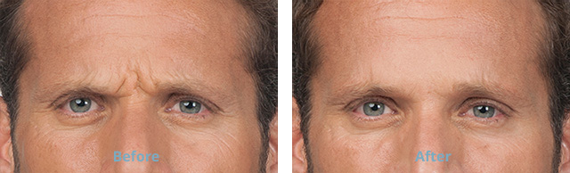 Before amd After botox