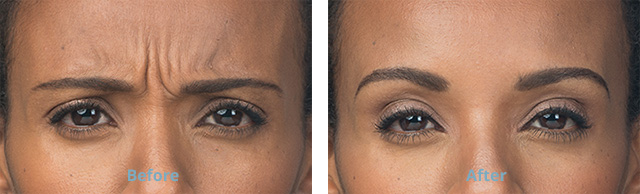 Before amd After botox