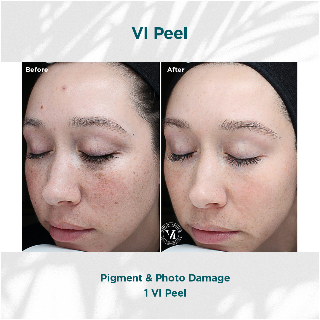 VI-Peel Pigment redcution before and after