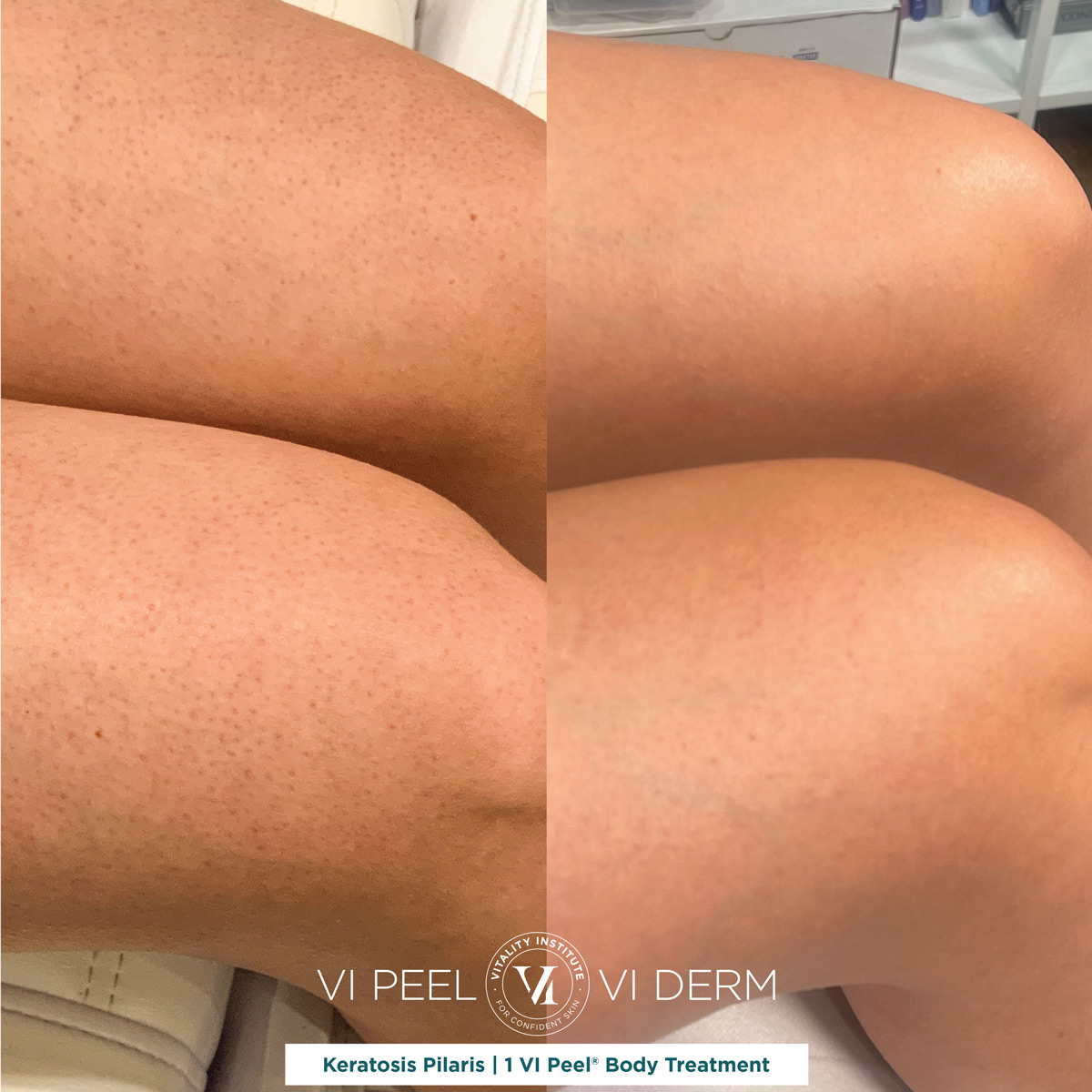 VI Peel Body Keratosis Pilaris Legs