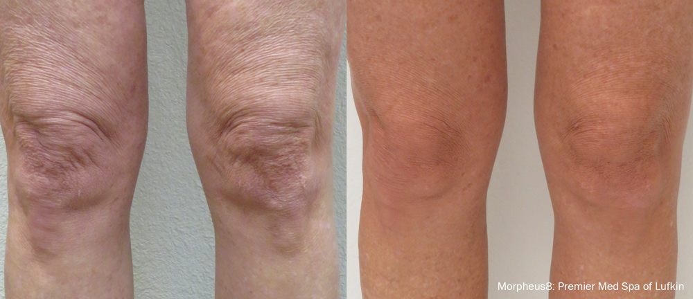 morpheus8 before after knees