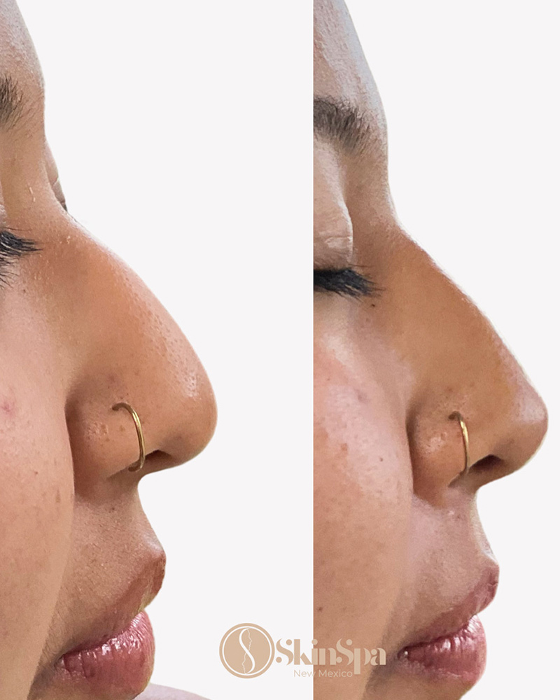 banda liquid rhinoplasty