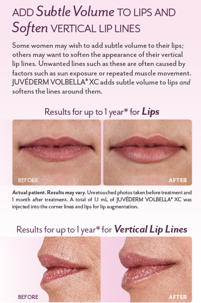 juvederm add lip volume