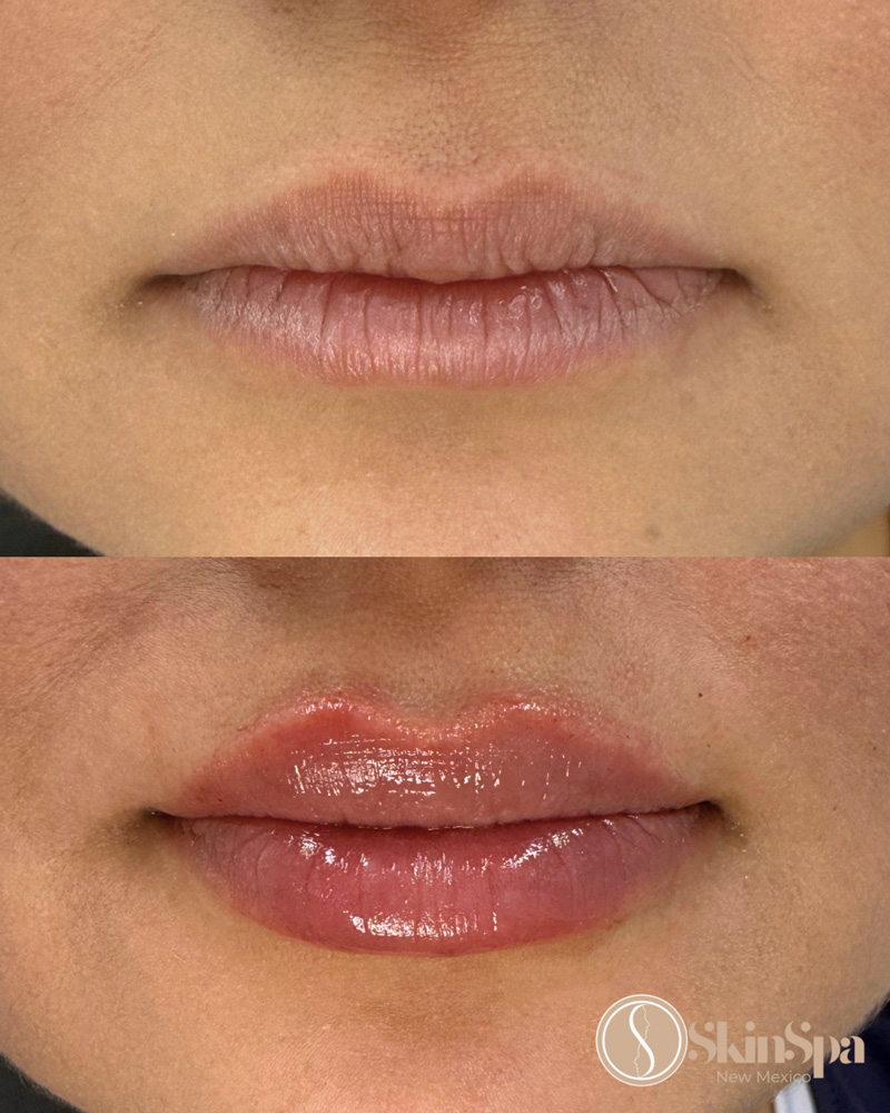 skinspa before and after photo - lips