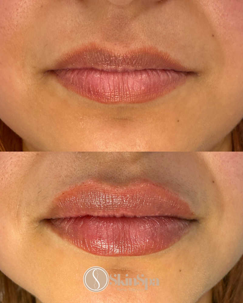 skinspa before and after photo - lips