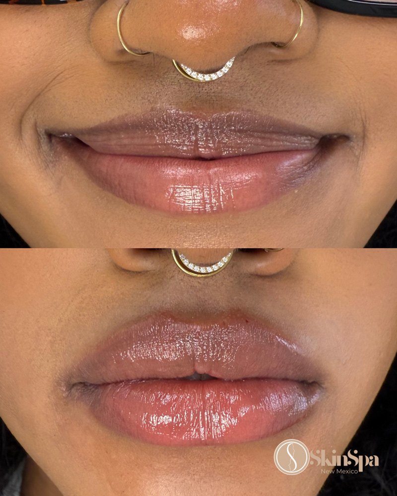 skinspa before and after lips