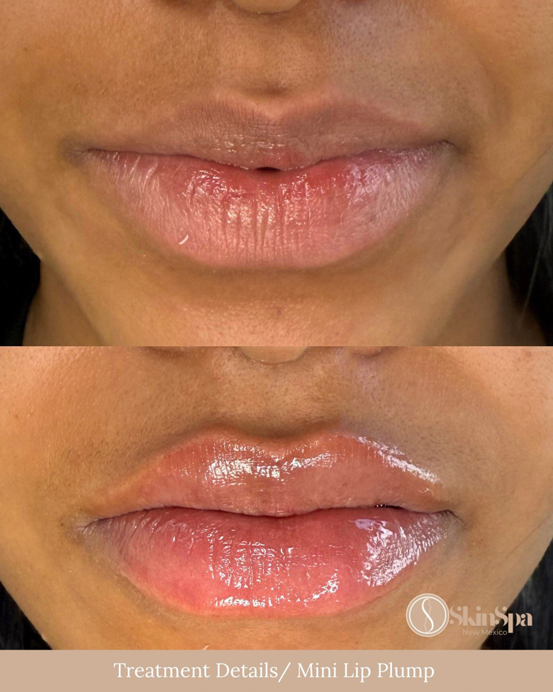skinspa before and after lift plump with juvederm
