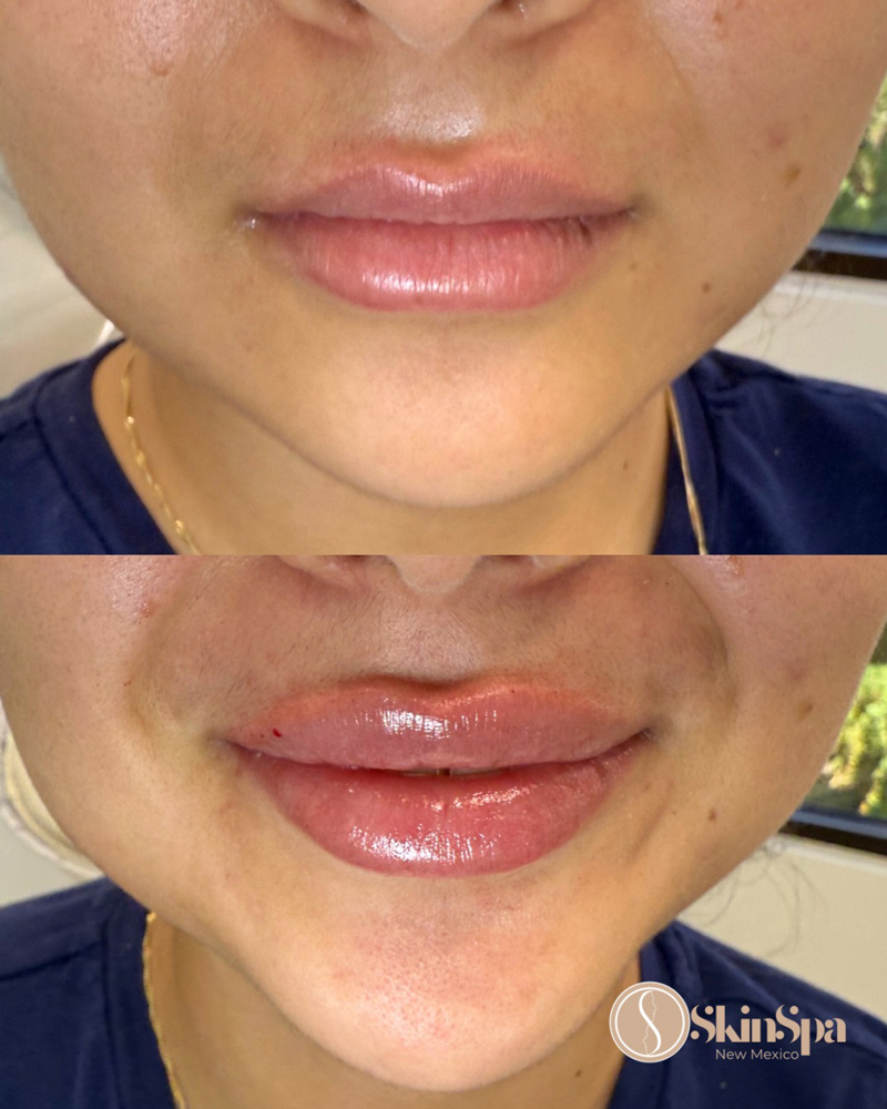 skin spa before and after photo - lip filler
