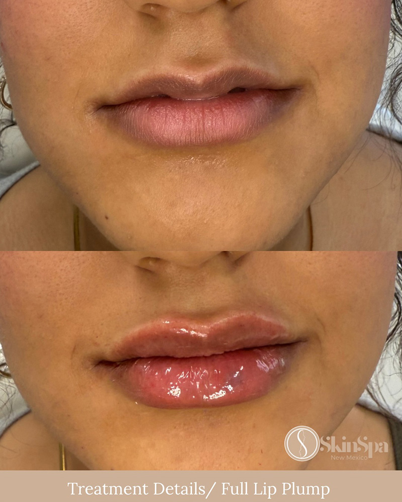 Lip Filler (full) using Juvederm or Evolysse Products