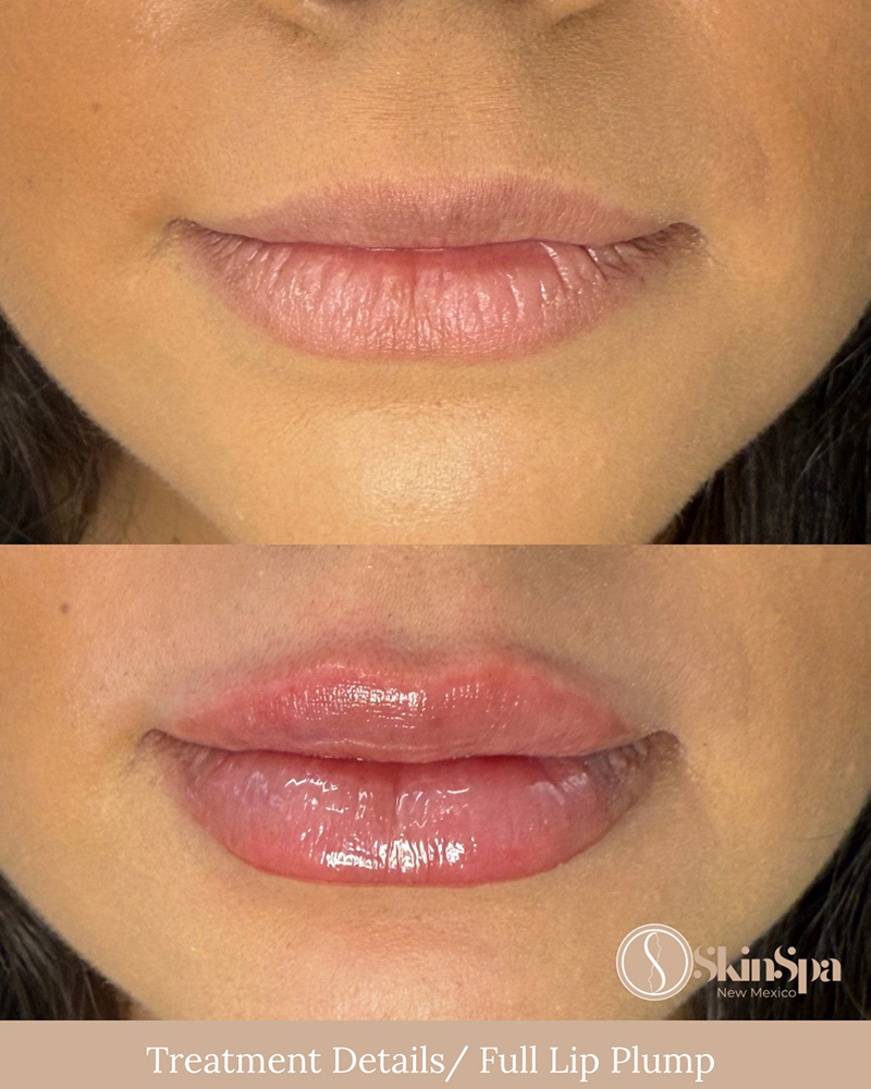 Lip Filler (full) using Juvederm or Evolysse Products