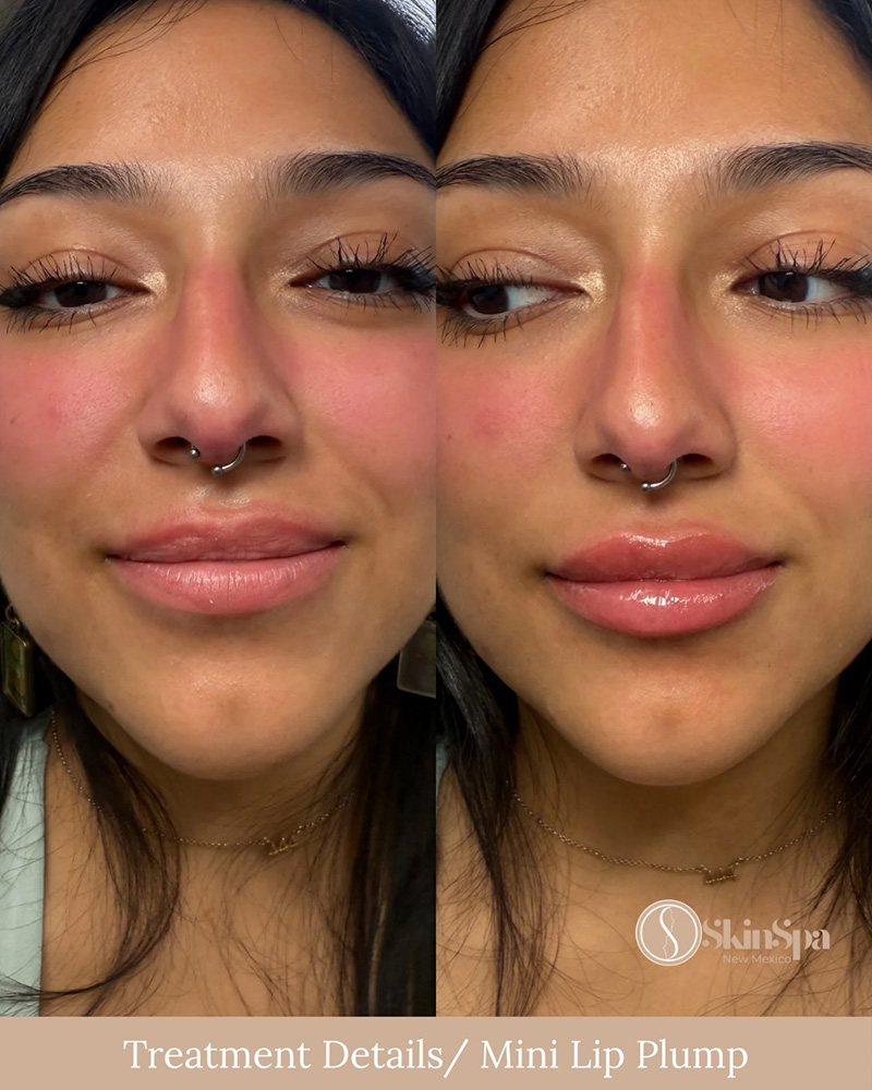 Lip Filler (mini) using Juvederm or Evolysse Products