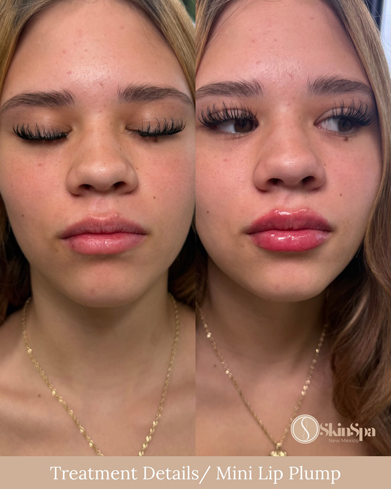 Lip Filler (mini) using Juvederm or Evolysse Products