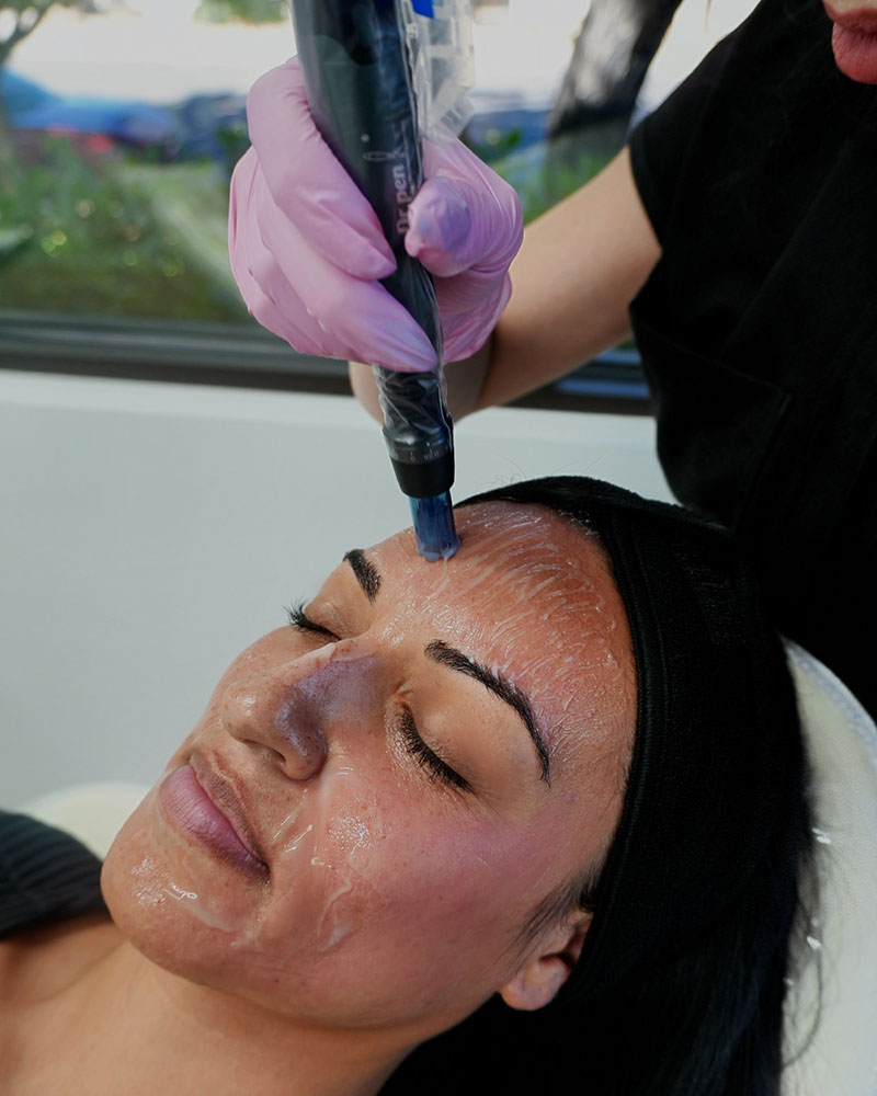 microneedling treatment