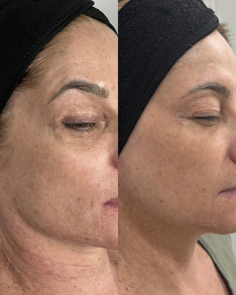 Before and after IPL