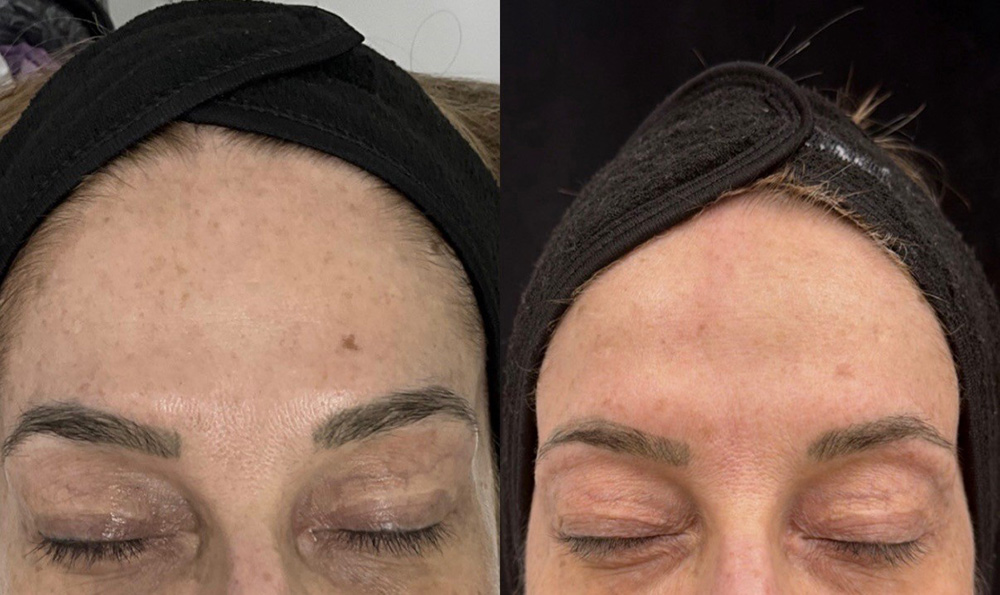 Before and after IPL