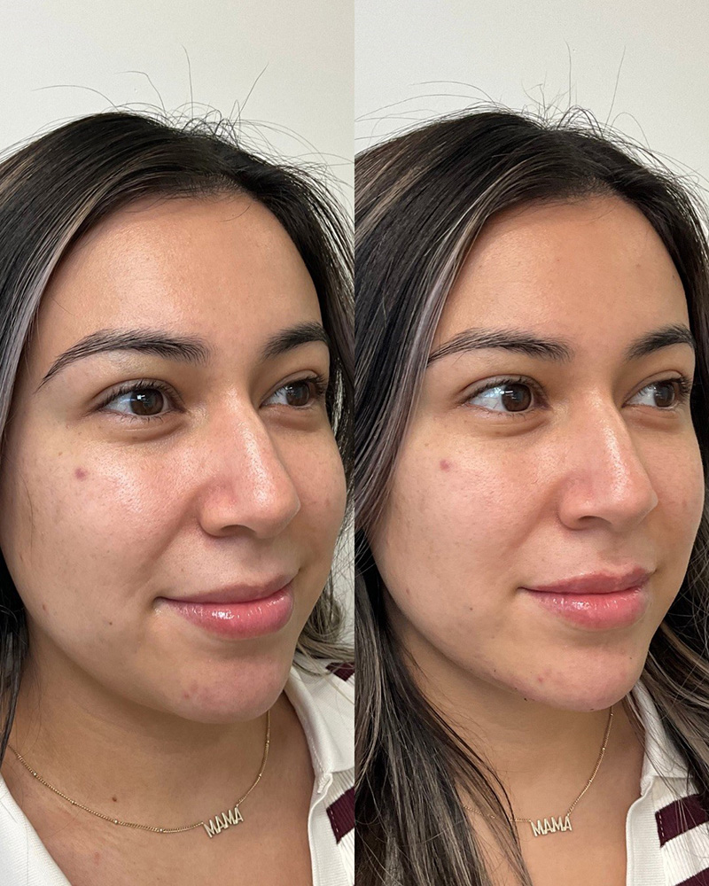Full facial balancing using evolysse or juvederm products