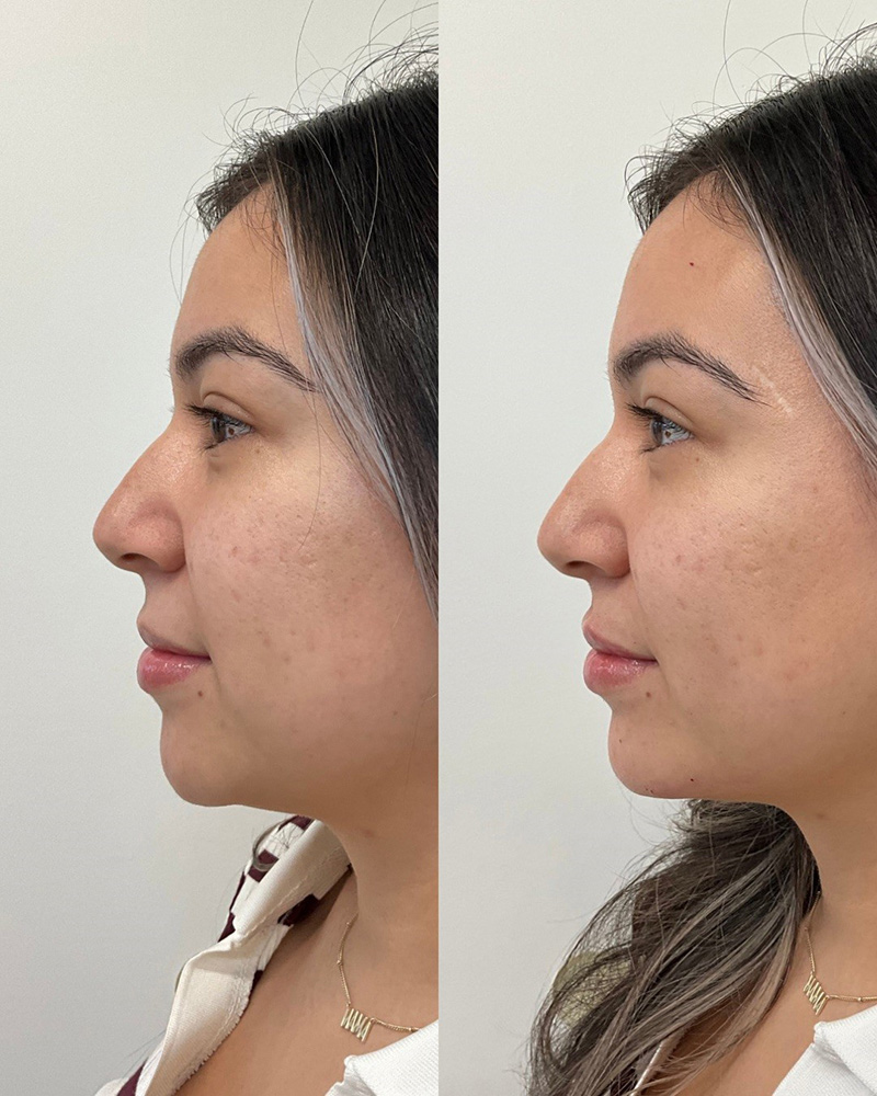 Full facial balancing using evolysse or juvederm products