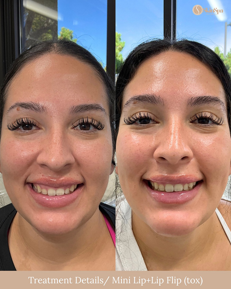 Lip Filler (mini) using Juvederm or Evolysse Products and Lip Flip