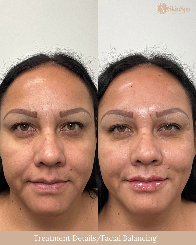 Full facial balancing using Juvederm or Evolysse Products