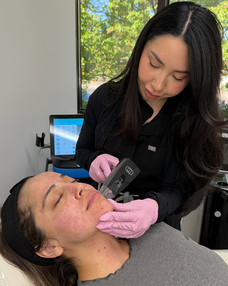 morpheus face treatment for acne